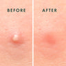 Set 2: Clear Skin Pack (Acne & Breakouts)