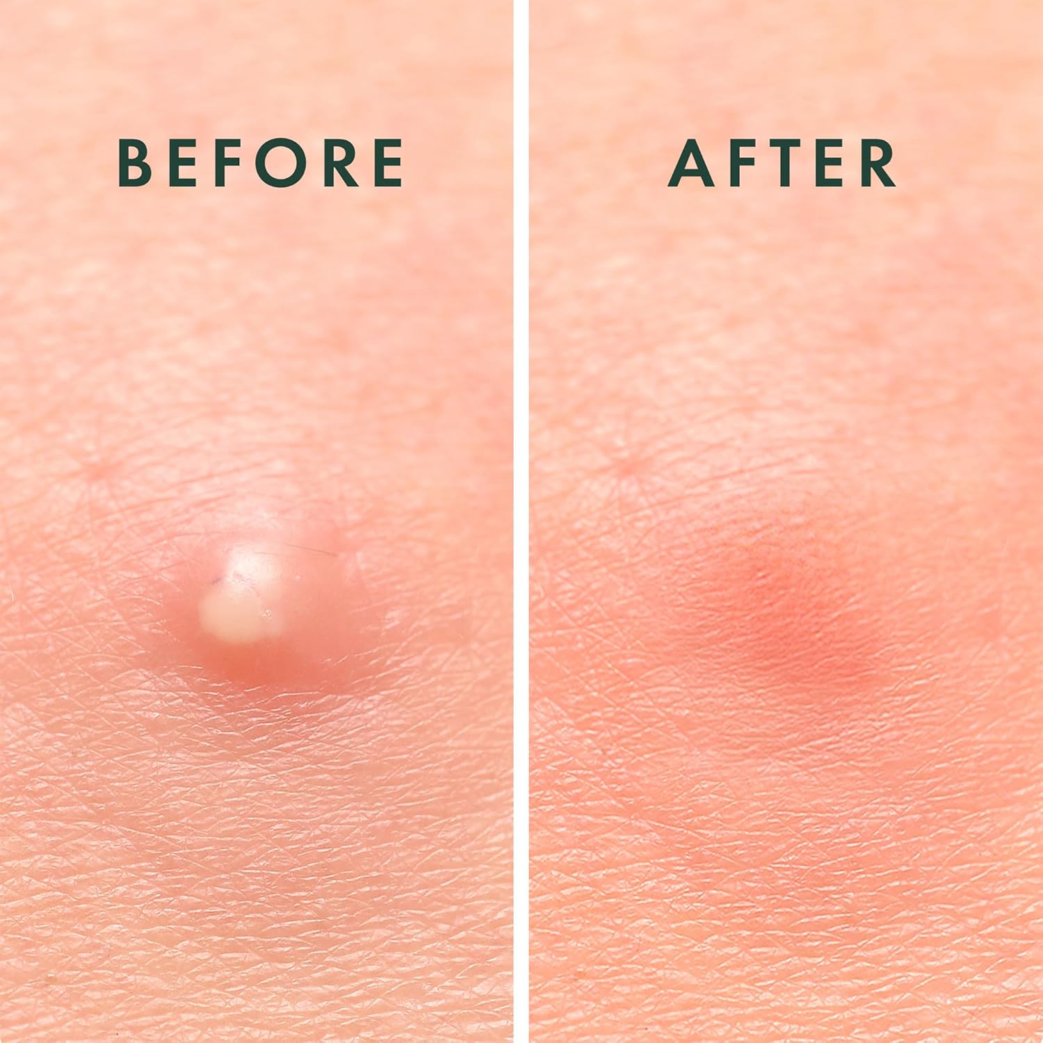 Smart Pack 3: Clear Pores Duo (Acne)